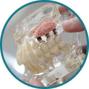 Bone Grafting