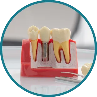 Dental Implants