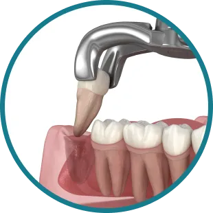 Tooth Extractions